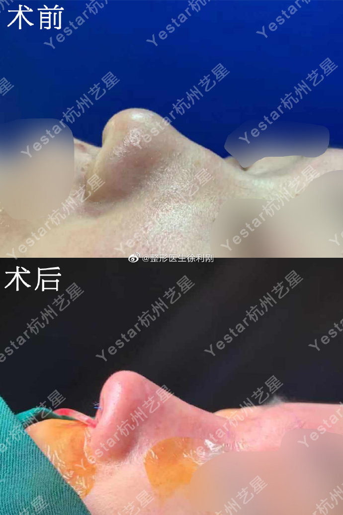 徐利剛鼻綜合案例