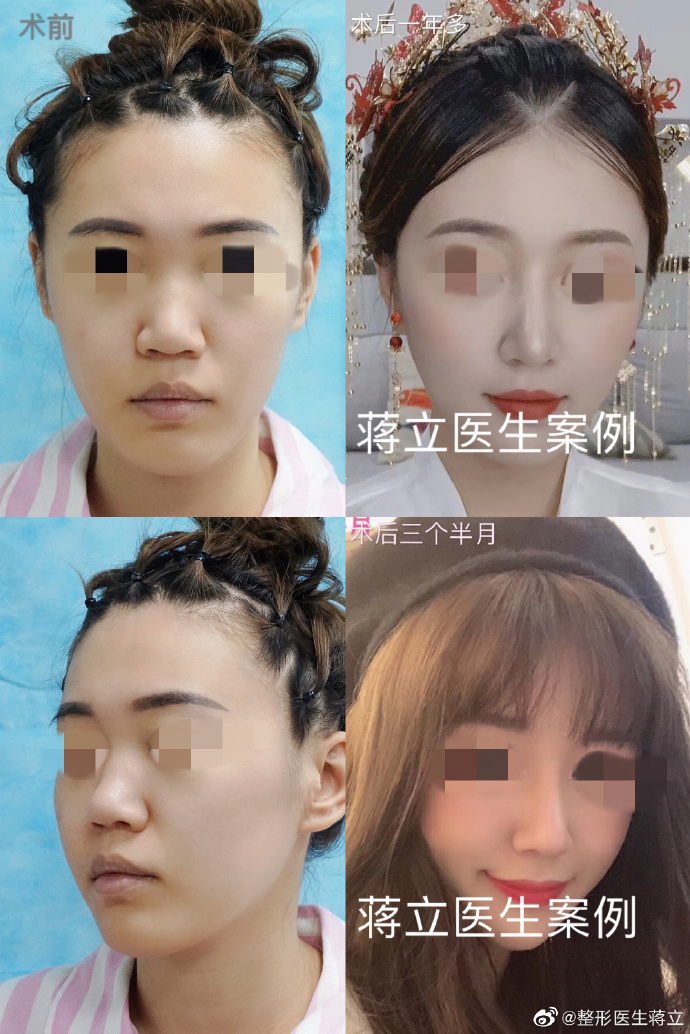 蔣立鼻綜合案例