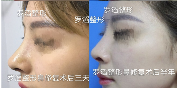 羅滔鼻綜合案例