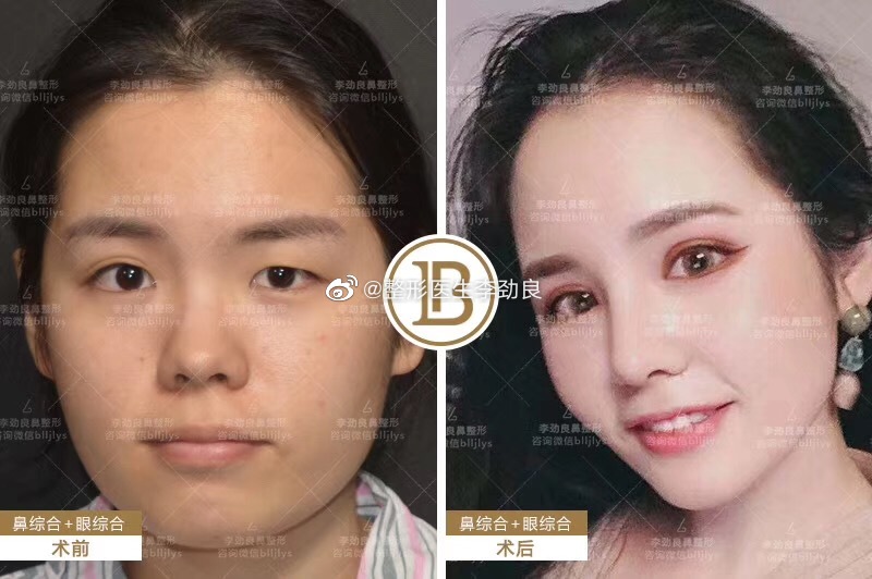 李勁良鼻修復案例