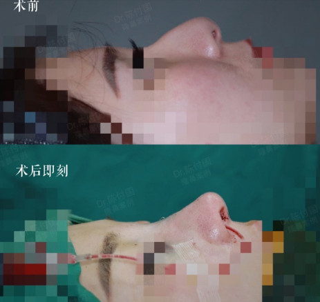 陳付國鼻修復案例