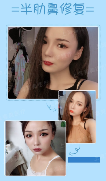 王會勇鼻修復案例
