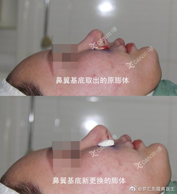 羅匯東鼻修復案例