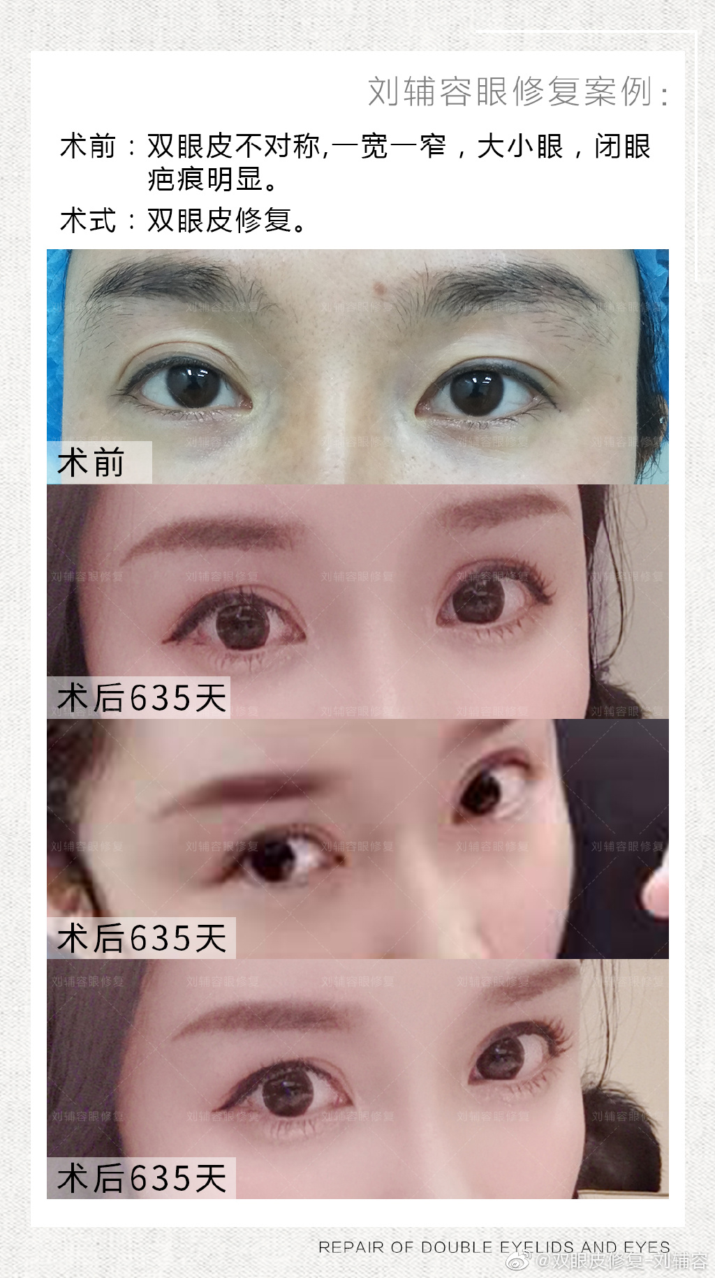 劉輔容眼修復(fù)案例