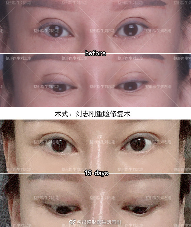 劉志剛眼修復(fù)案例