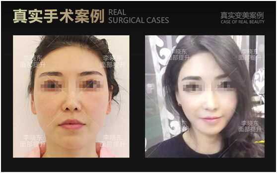 李曉東和楊博哪個面部提升更好？