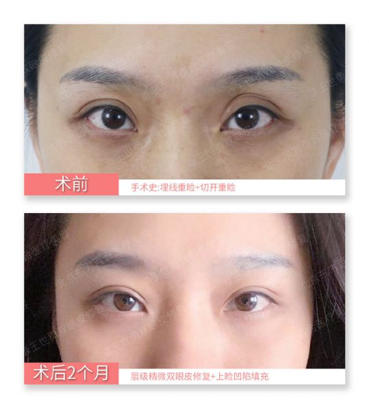 北京知名雙眼皮修復(fù)專家是哪個？北京雙眼皮修復(fù)專家名單