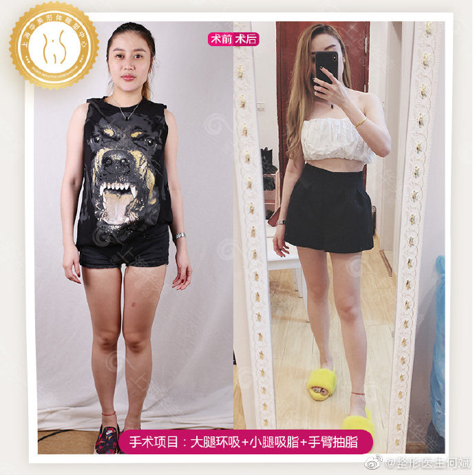 上海吸脂最厲害的醫(yī)院，上海大腿吸脂多少錢？