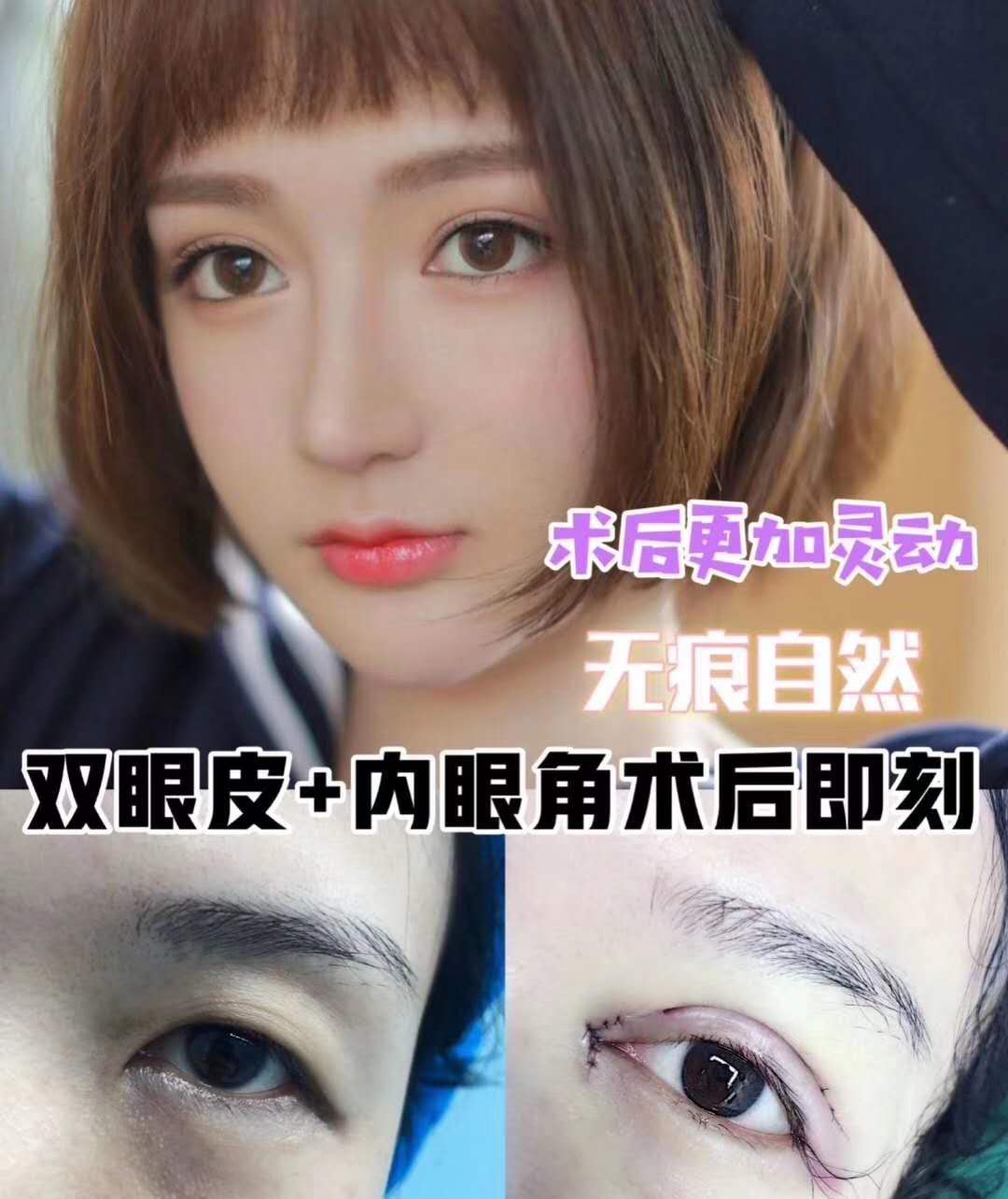 成都雙眼皮手術哪家好？成都雙眼皮醫生排名