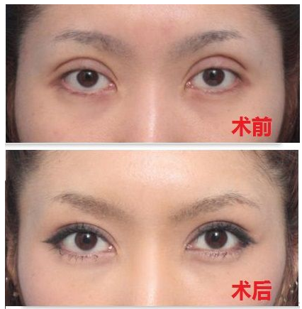 深圳雙眼皮修復哪位醫(yī)生比較好？深圳雙眼皮修復專家排行榜