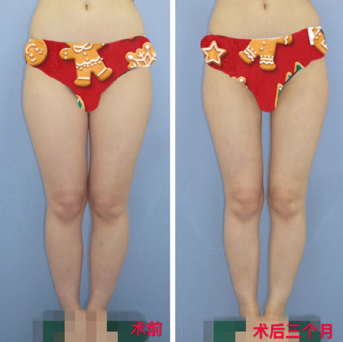 北京八大處大腿吸脂醫生哪個好？北京八大處大腿吸脂醫生排行榜