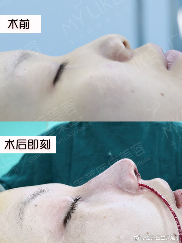 廣州隆鼻比較好的醫(yī)生是哪個？