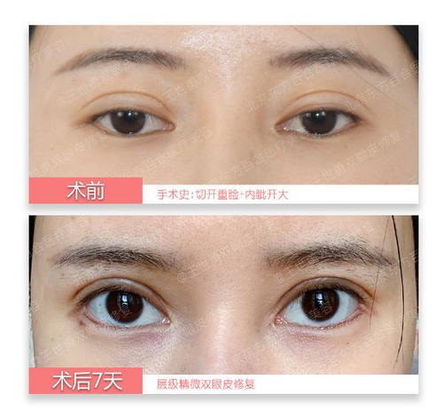 合肥雙眼皮修復哪個醫生專家做的好？
