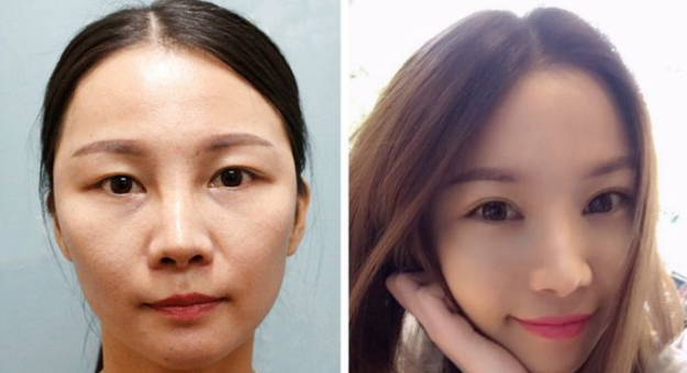 南寧雙眼皮手術做得最專業的醫生是哪個？