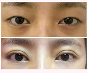 福州雙眼皮做得最好的醫(yī)生是誰？