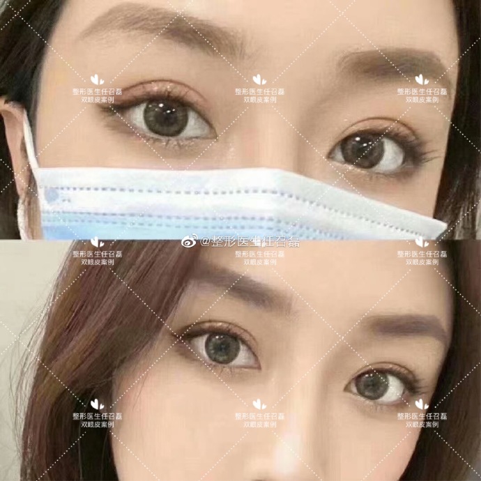任召磊雙眼皮案例
