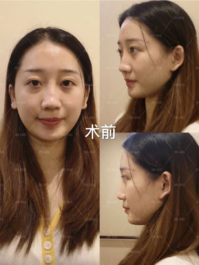 朱燦鼻整形案例