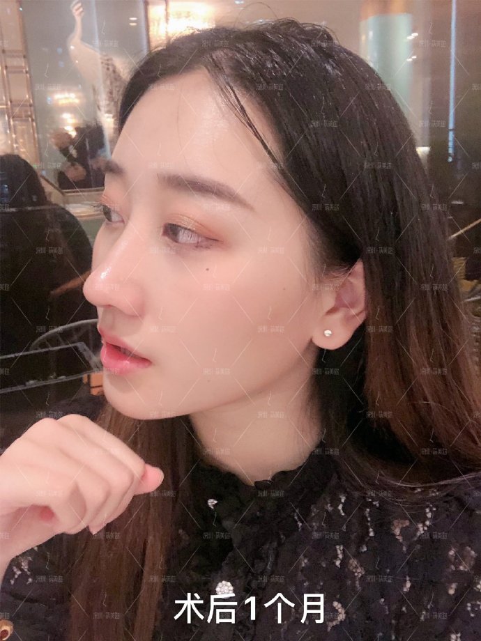 朱燦鼻修復(fù)案例
