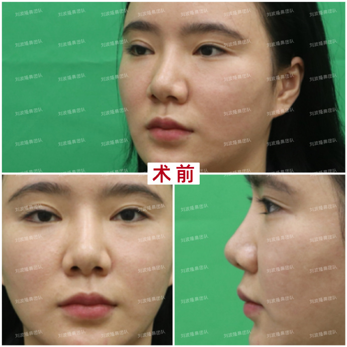劉波隆鼻案例