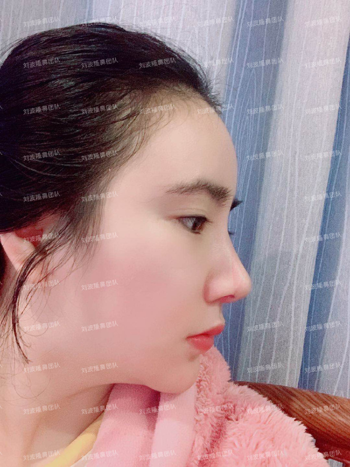 劉波隆鼻案例