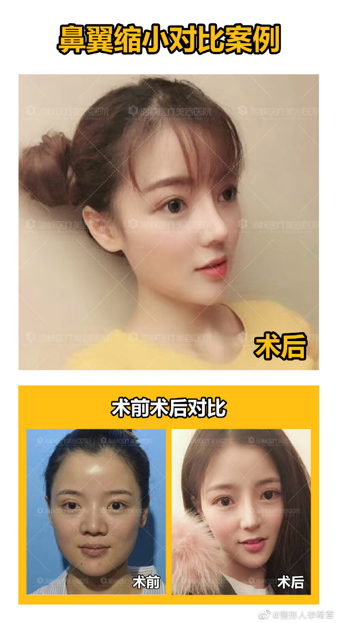 李希軍隆鼻案例