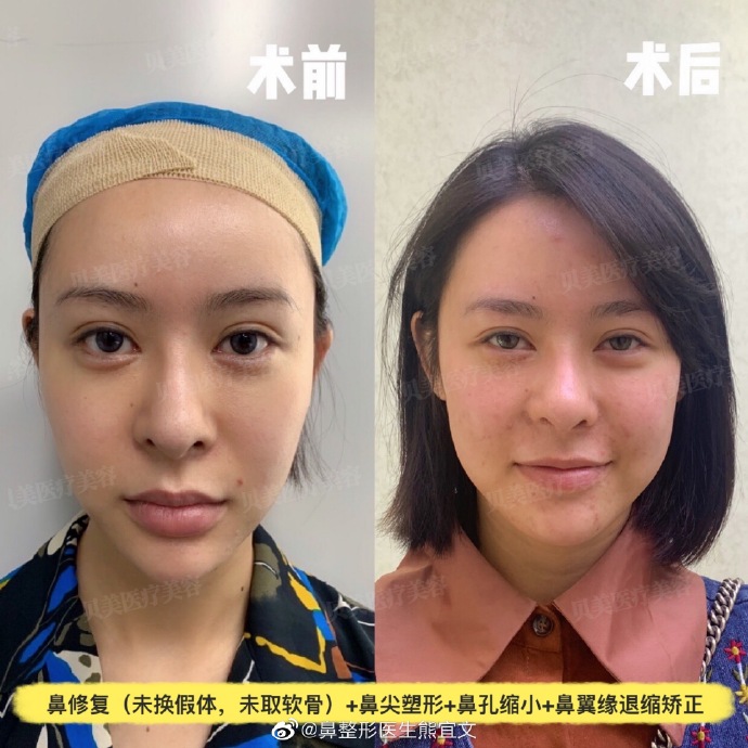 熊宜文鼻修復(fù)案例