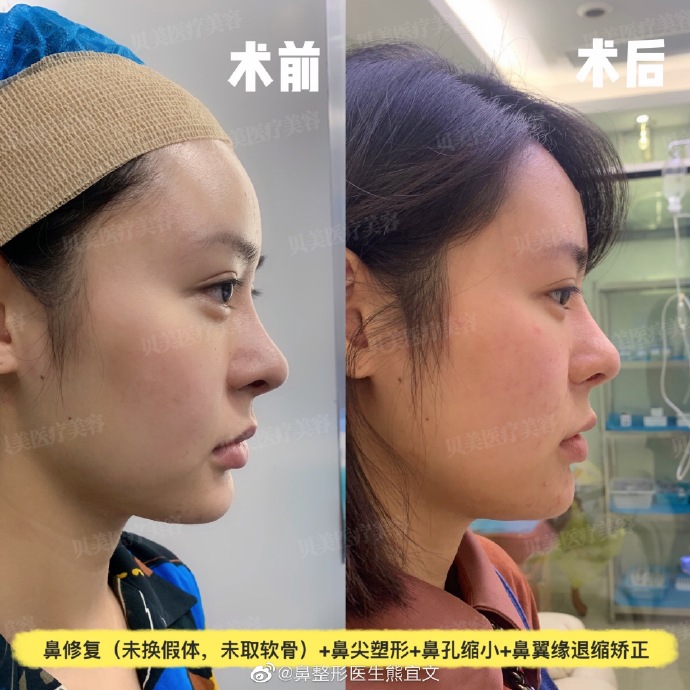 熊宜文鼻修復(fù)案例