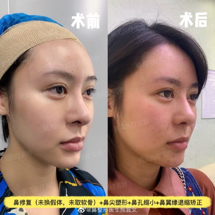 熊宜文鼻修復(fù)案例