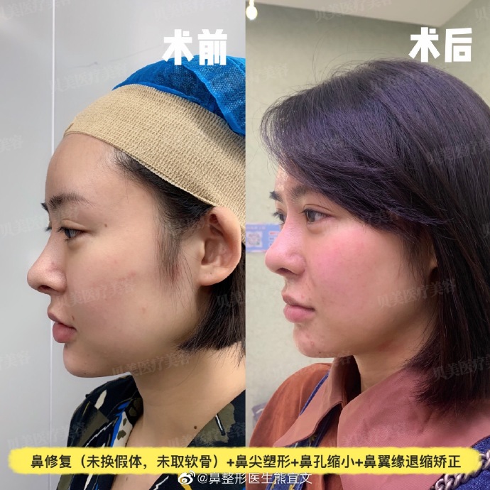 熊宜文鼻修復(fù)案例