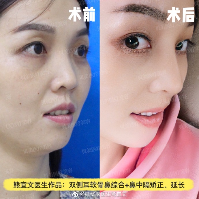 熊宜文鼻綜合案例