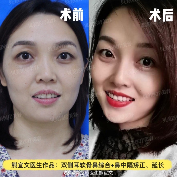 熊宜文鼻綜合案例