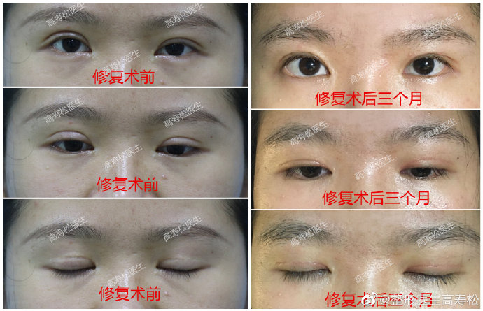 高壽松眼修復案例