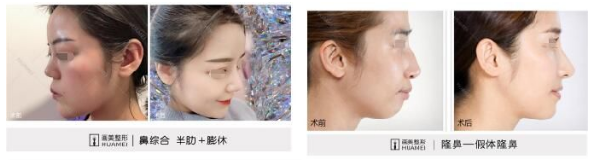 楊萬忠鼻整形案例
