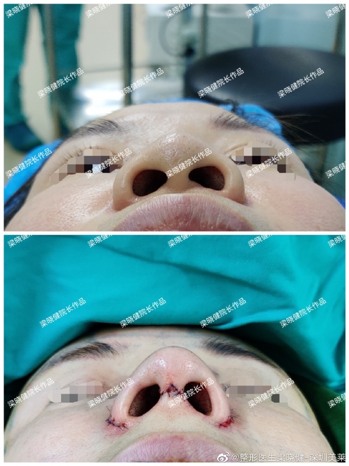梁曉健隆鼻案例