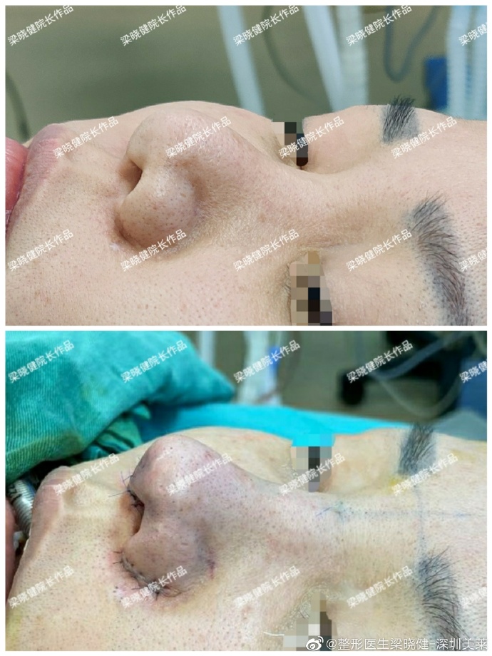 梁曉健隆鼻案例