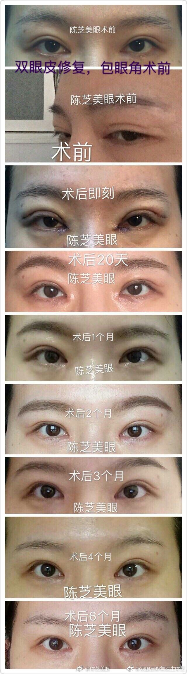 陳芝修復(fù)雙眼皮案例