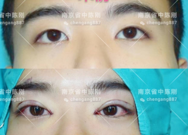 陳剛割雙眼皮案例