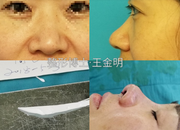 王金明做鼻綜合案例