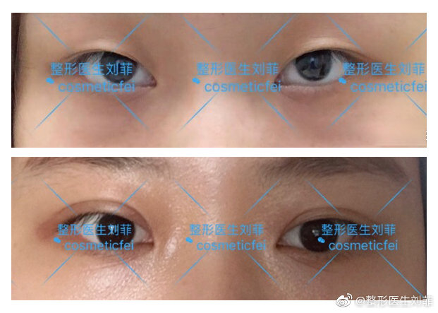 劉菲割雙眼皮案例