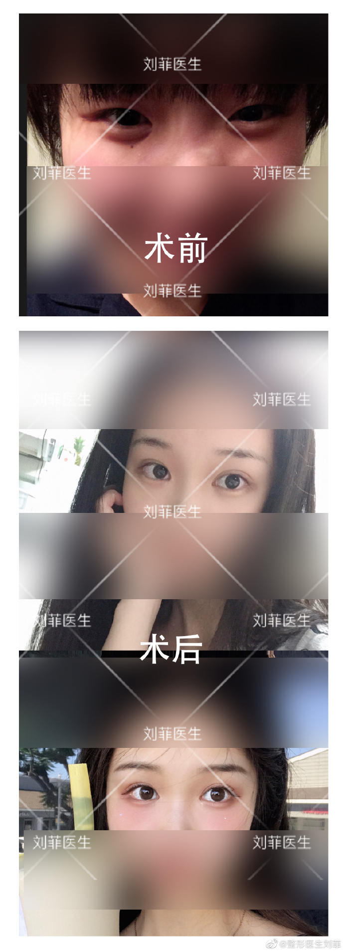 劉菲割雙眼皮案例