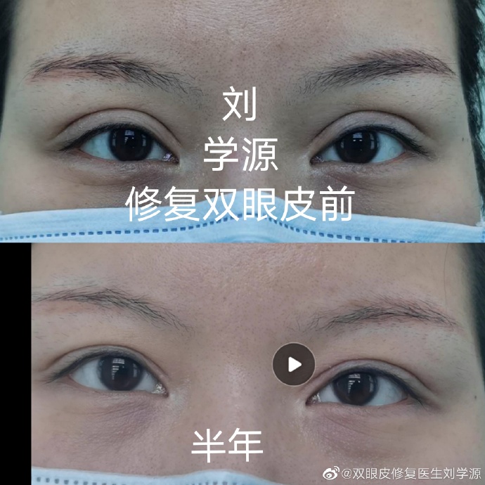 劉學源雙眼皮修復案例