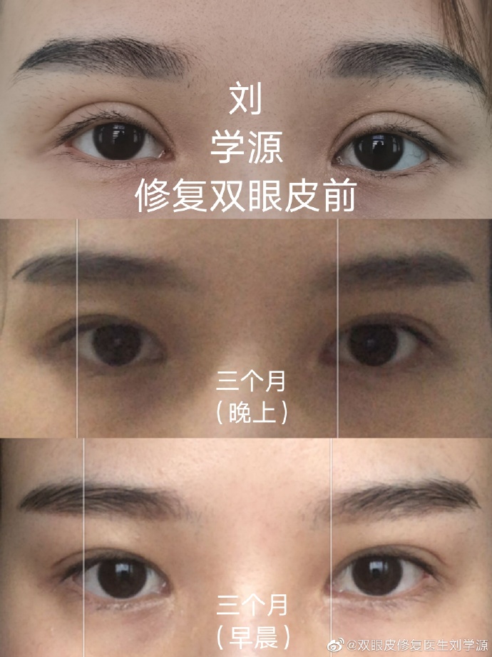 劉學源雙眼皮修復案例