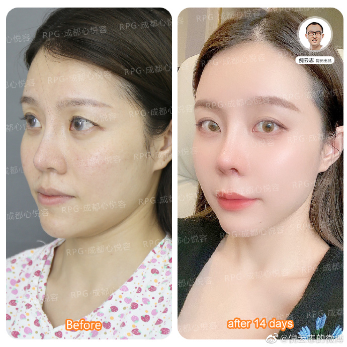 倪云志鼻修復案例