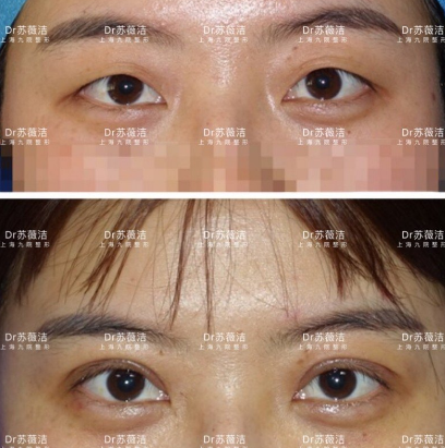 蘇薇潔雙眼皮案例