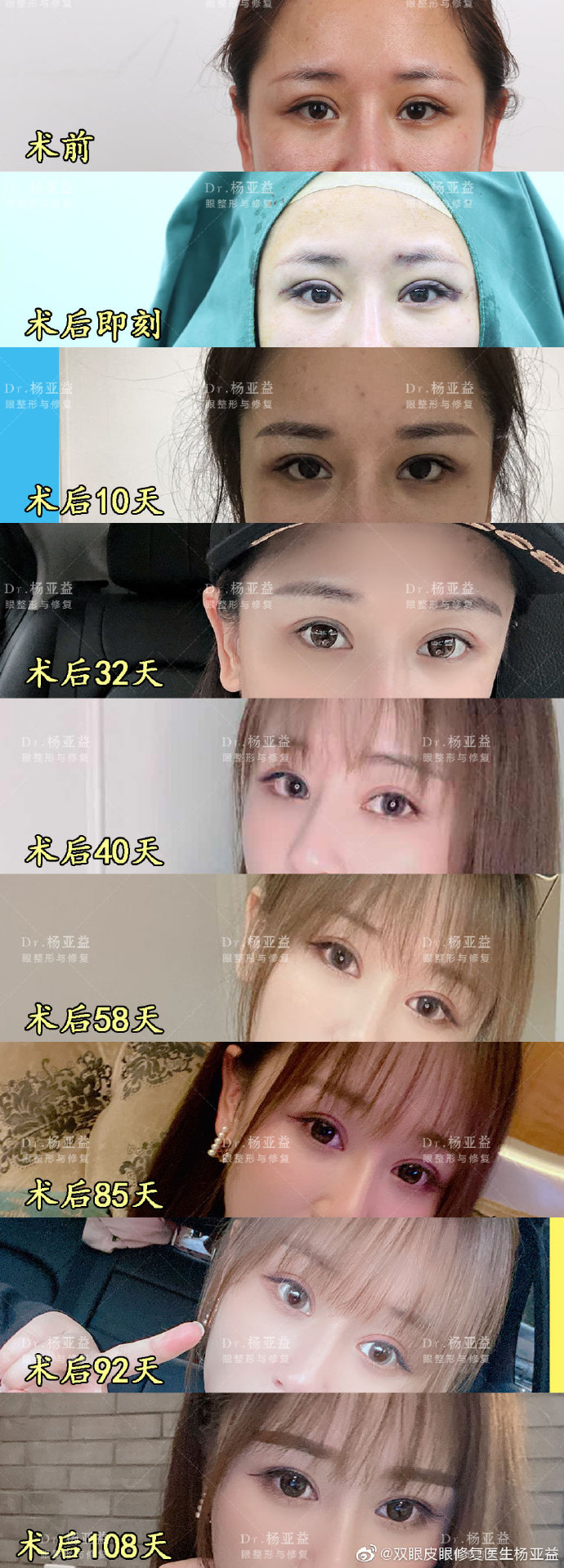 楊亞益雙眼皮修復(fù)案例