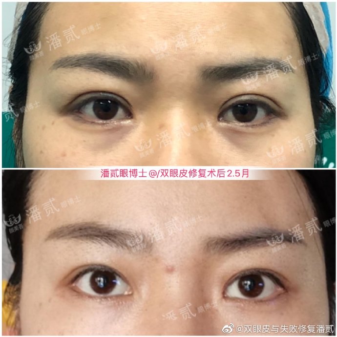 潘貳雙眼皮修復案例