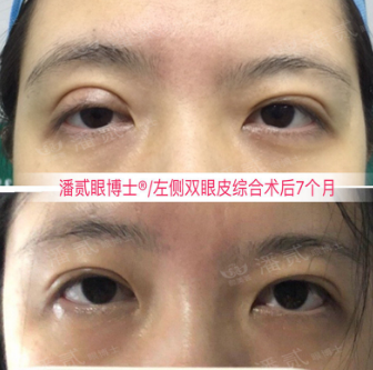 潘貳雙眼皮修復案例