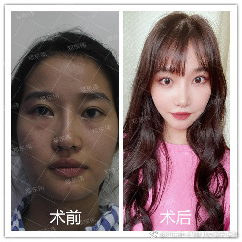 鄧東偉鼻修復案例