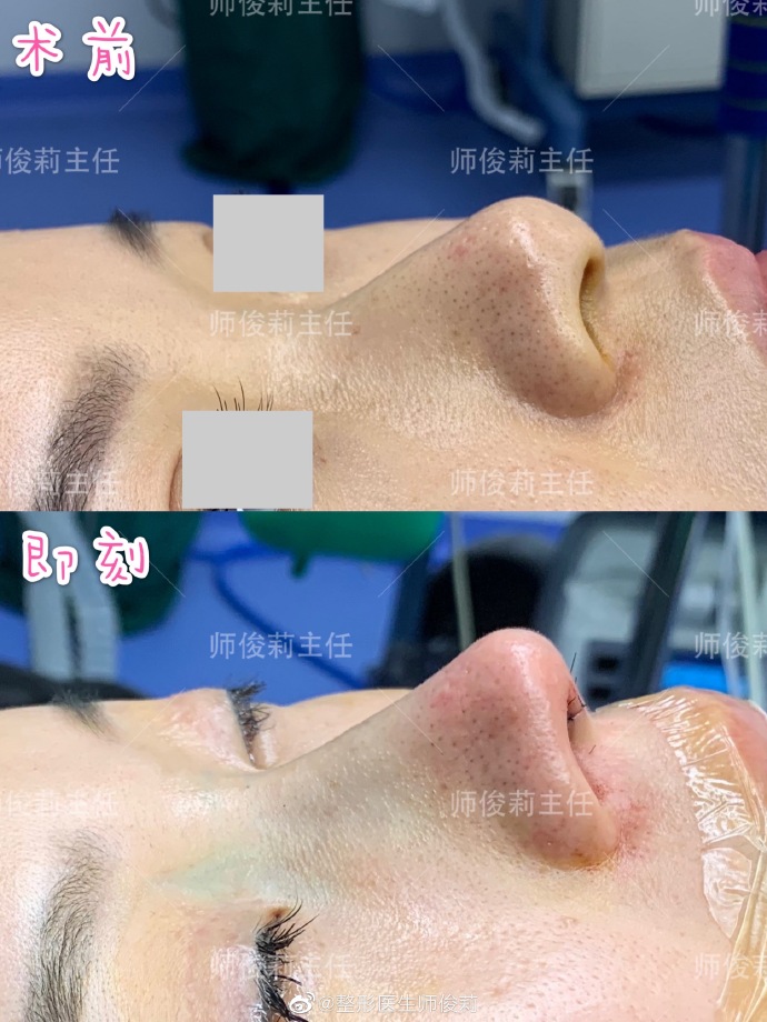 師俊麗鼻整形案例