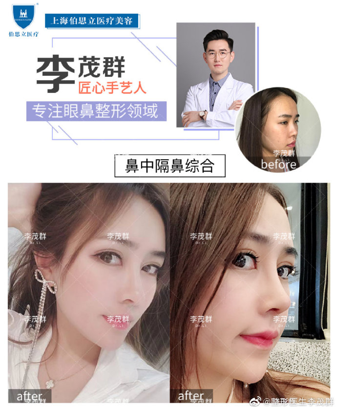 李茂群鼻綜合案例